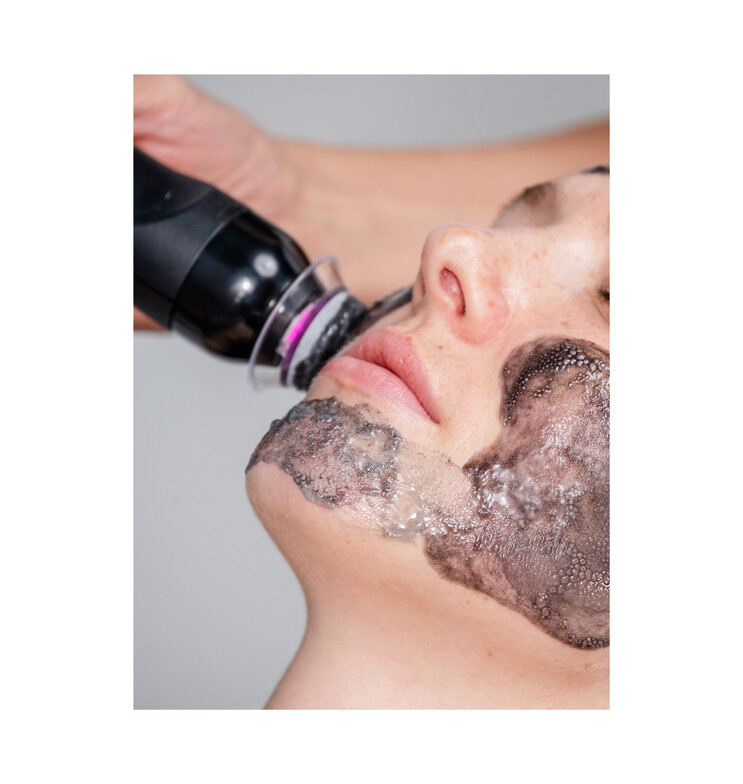 Professional facial treatment with deep exfoliation and cleansing to improve skin health, texture, and overall complexion