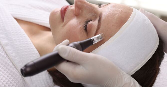 What Is Microneedling and How Can It Help With Acne Scars?